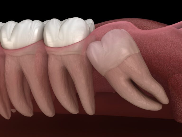 can-wisdom-teeth-cause-tinnitus-treble-health