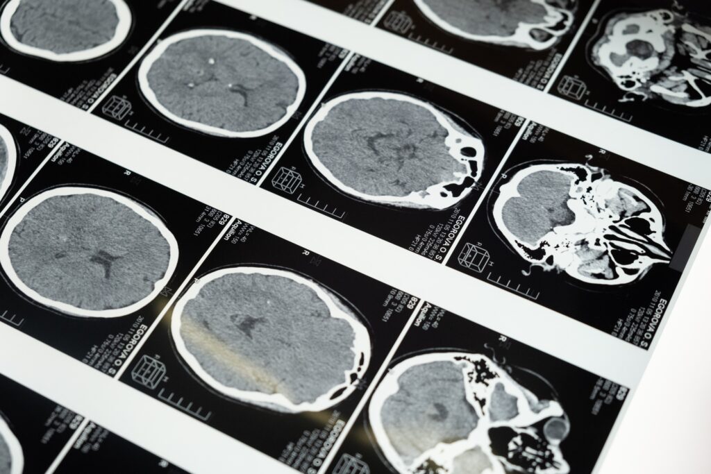 Xray images of brain scans 