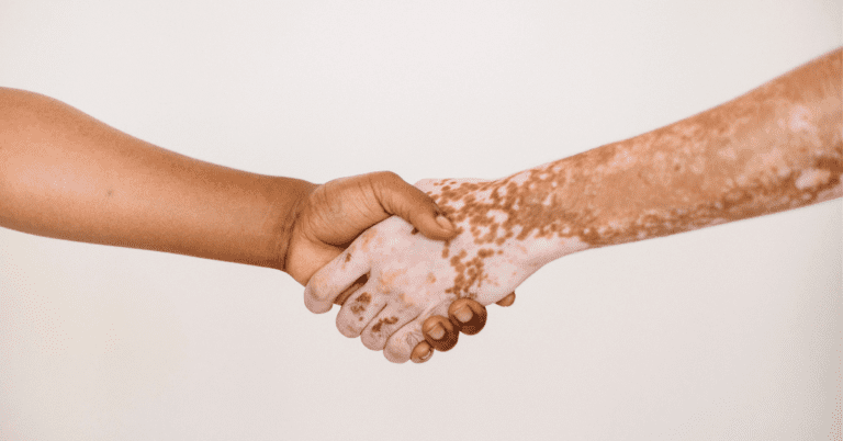 Person with vitiligo shaking hands with someone else