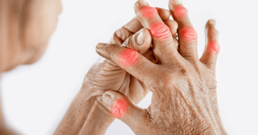 Woman with arthritis in her hands holding her fingers