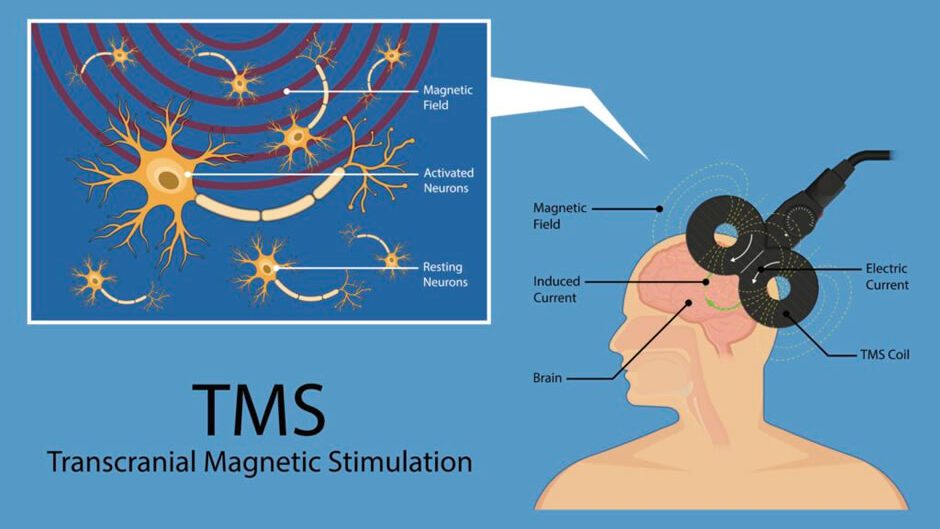 Diagram of Transcranial Magnetic Stimulation (TMS)
