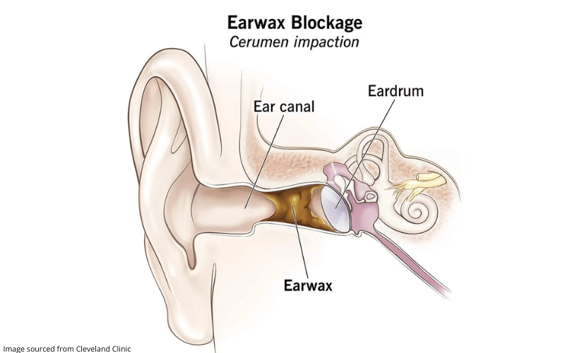 Diagram detailing what happens when there is an earwax blockage in the ear