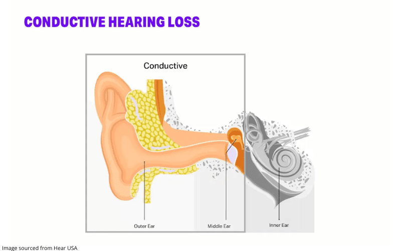 Diagram explaining conductive hearing loss
