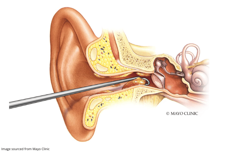 Diagram showing earwax being removed