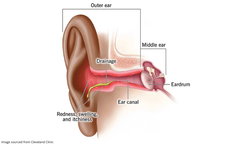 Diagram showing how swimmer's ear happens