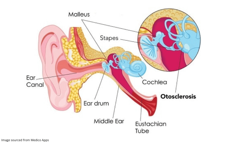 Diagram showing what otosclerosis is 